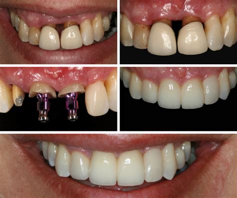  Ceramics: Alta Resistência e Biocompatibilidade em Implantes Dentários!