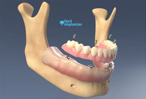  Juddite: Desvendando a Magia da Superestrutura Metálica em Implantes Dentários!