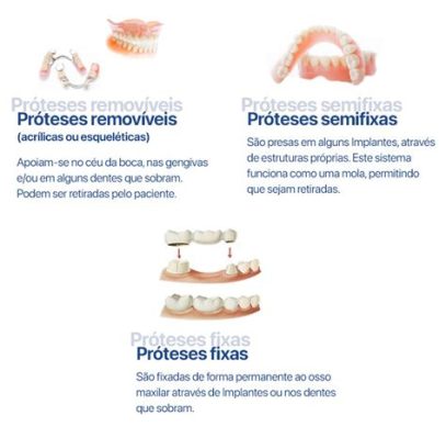  Zinco-Aluminato de Estrôncio: A Revolução na Reação de Próteses Dentárias e Biocompatabilidade Superior?